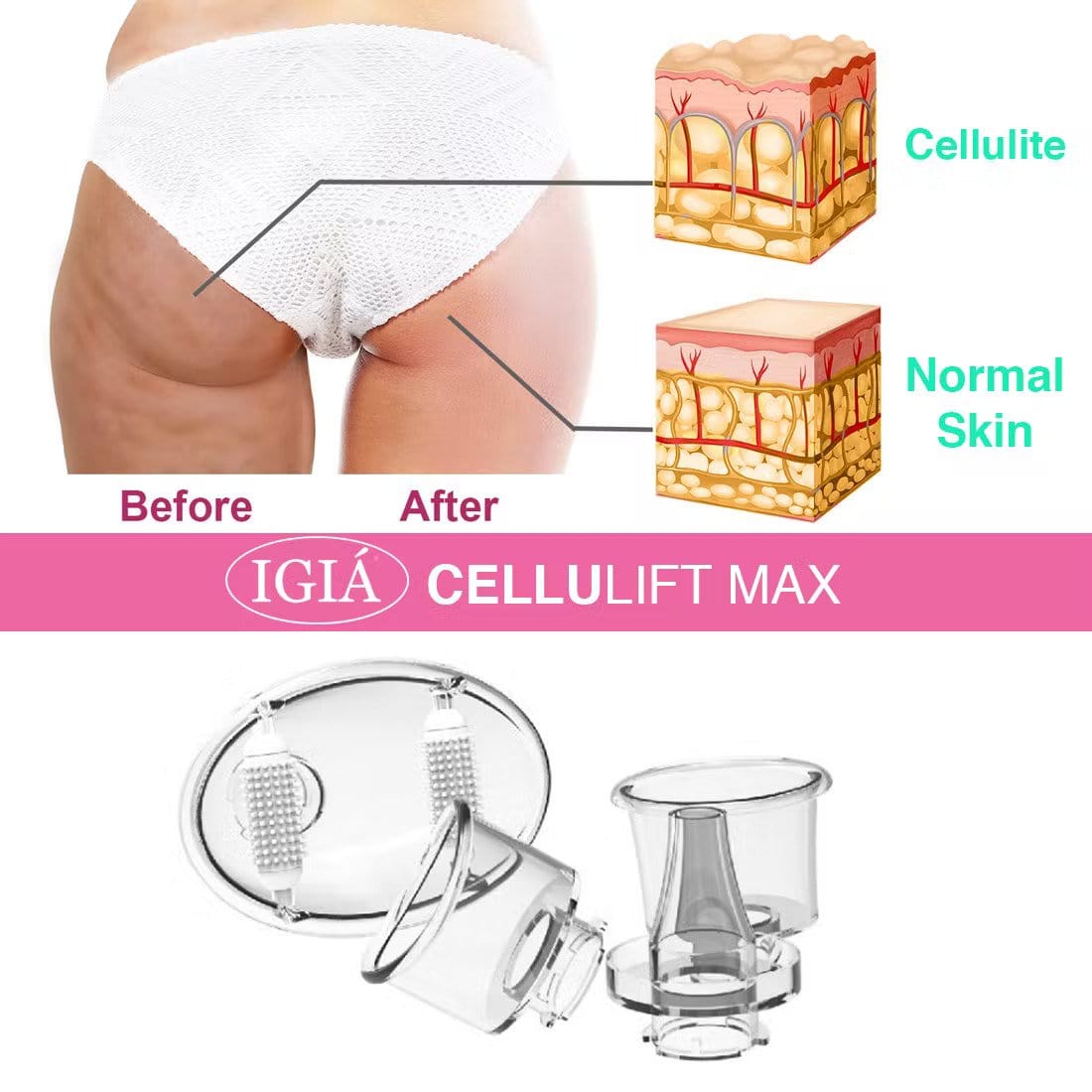 Cellulift Max Cellulite Reducing Suction Vacuum Massager BK3300
